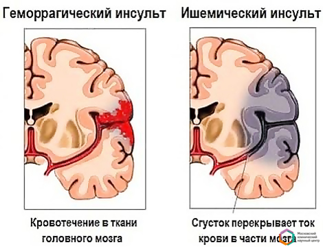 Схема мозгового кровообращения