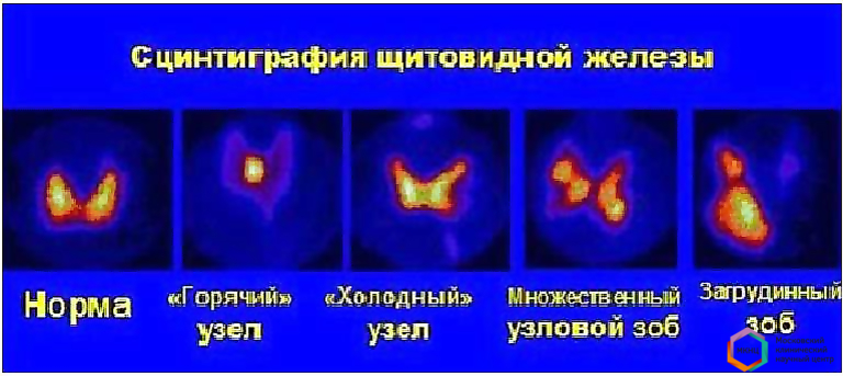 Может ли сцинтиграфия не увидеть мтс