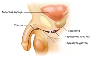 Инстилляции в уретру