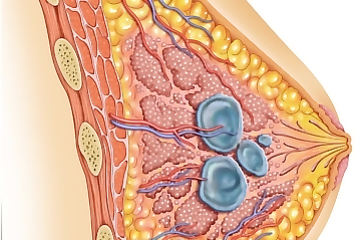 Лечение фиброзной мастопатии молочных желез. Признаки, симптомы и отзывы.