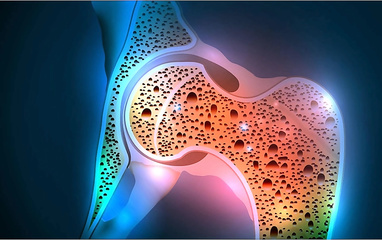 Osteoporosis. Symptoms and...