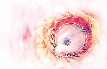 Carotid artery stenting