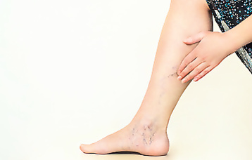 Varicose veins. What is...