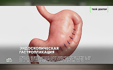 Endoscopic gastroplication....