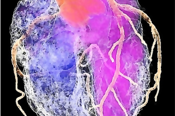 CT-coronarography